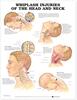 Whiplash Injuries of the Head and Neck Anatomical Chart