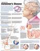 Understanding Alzheimer's Disease Anatomical Chart
