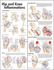 Hip and Knee Inflammations Anatomical Chart