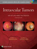 Intraocular Tumors: An Atlas and Textbook