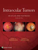 Intraocular Tumors: An Atlas and Textbook