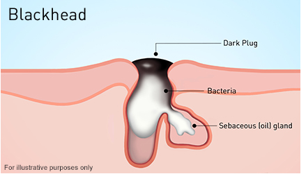 Blackhead