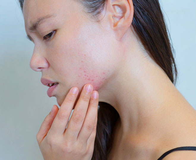 Skin Purging vs Breakouts