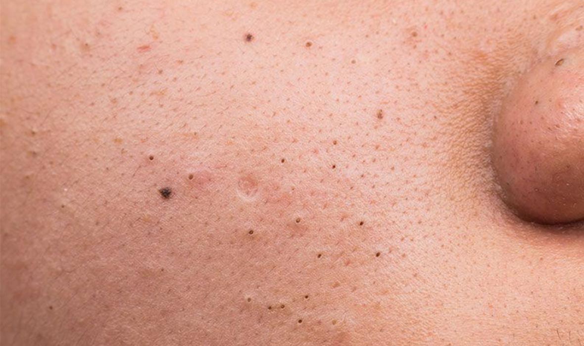 Blackheads