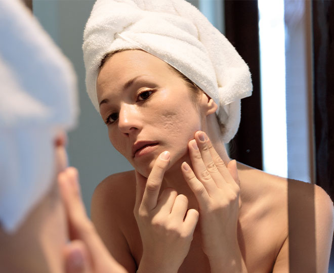 How to treat and prevent acne scars