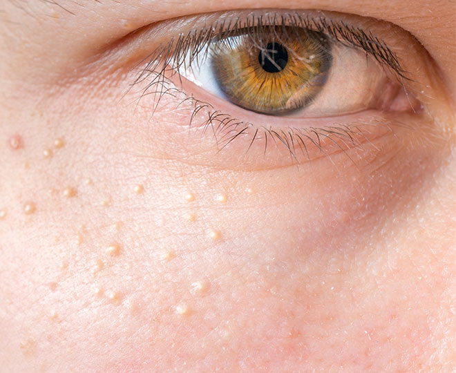 What are those tiny bumps on your face?